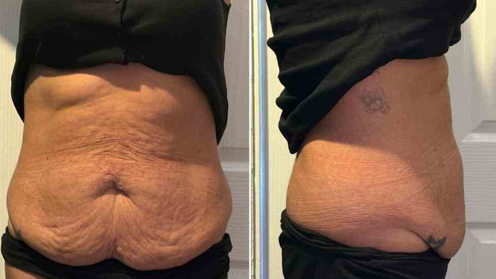 Lost the Weight but Not the Loose Skin? What You Should Know 1 Is It Definitely Loose Skin Aylesbury?
